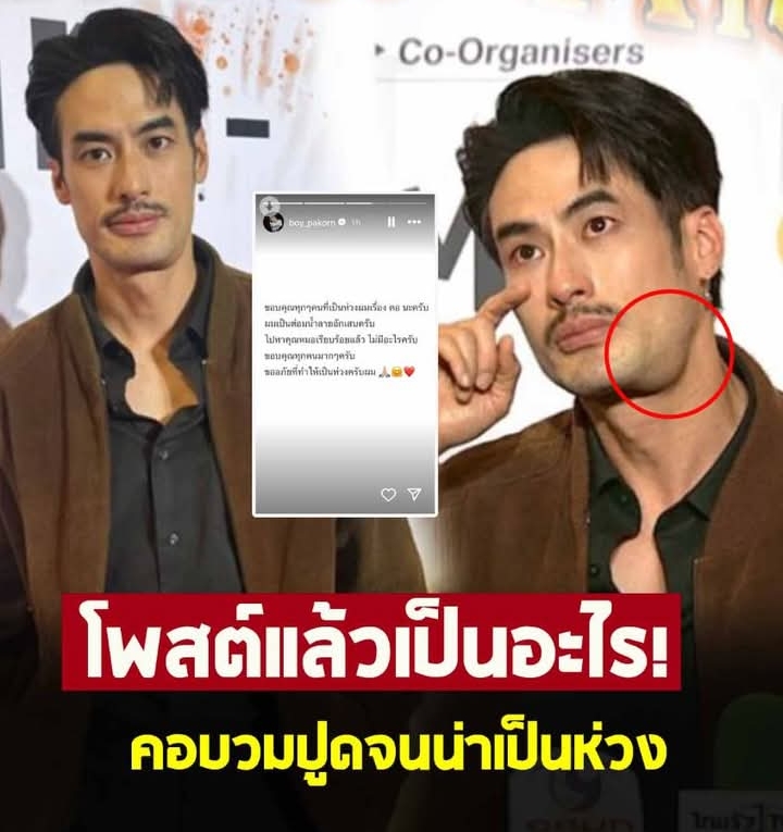 บอย ปกรณ์ โพสต์แล้ว หลังคอบวมปูดจนน่าเป็นห่วง