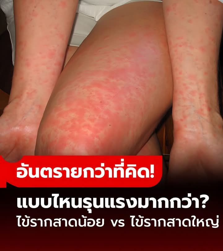 “ไข้รากสาดน้อย” กับ “ไข้รากสาดใหญ่” ต่างกันอย่างไร? แบบไหนอันตรายกว่า?