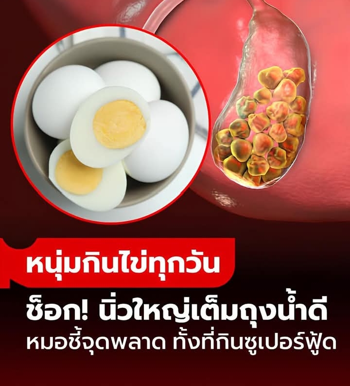 หนุ่มวัย 23 นิ่วใหญ่เต็มถุงน้ำดี แค่เพราะ “กินไข่ทุกวัน” กลับต้องทรมาน หมอชี้จุดพลาด?!